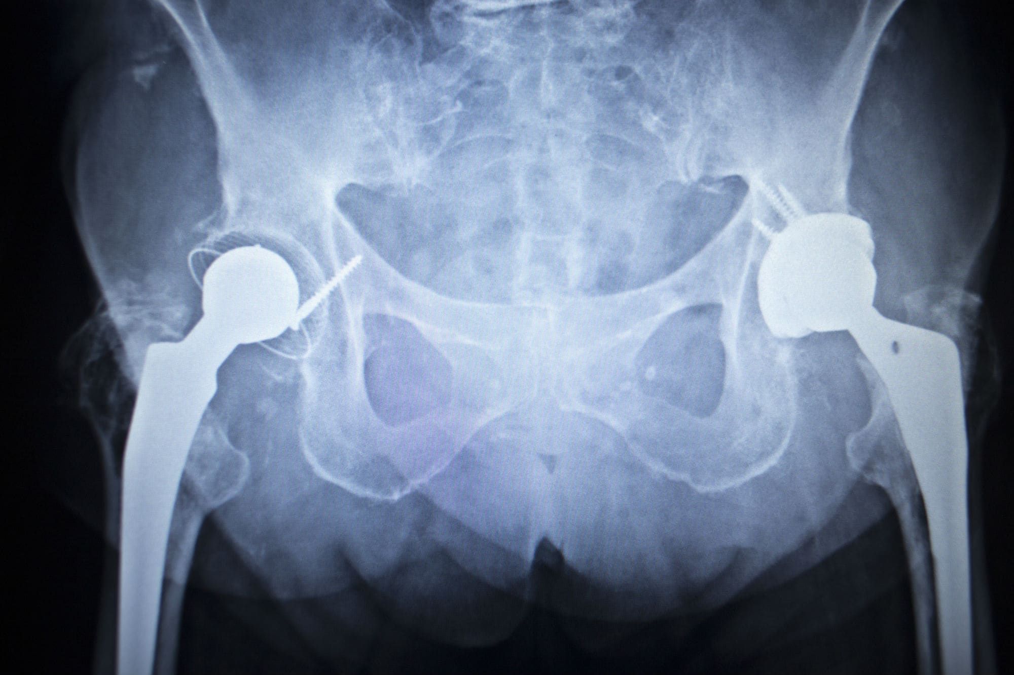 Couple Sues Biomet After Two Failed MetalonMetal Hip Replacement