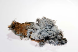 Asbestos exposure can cause mesothelioma.
