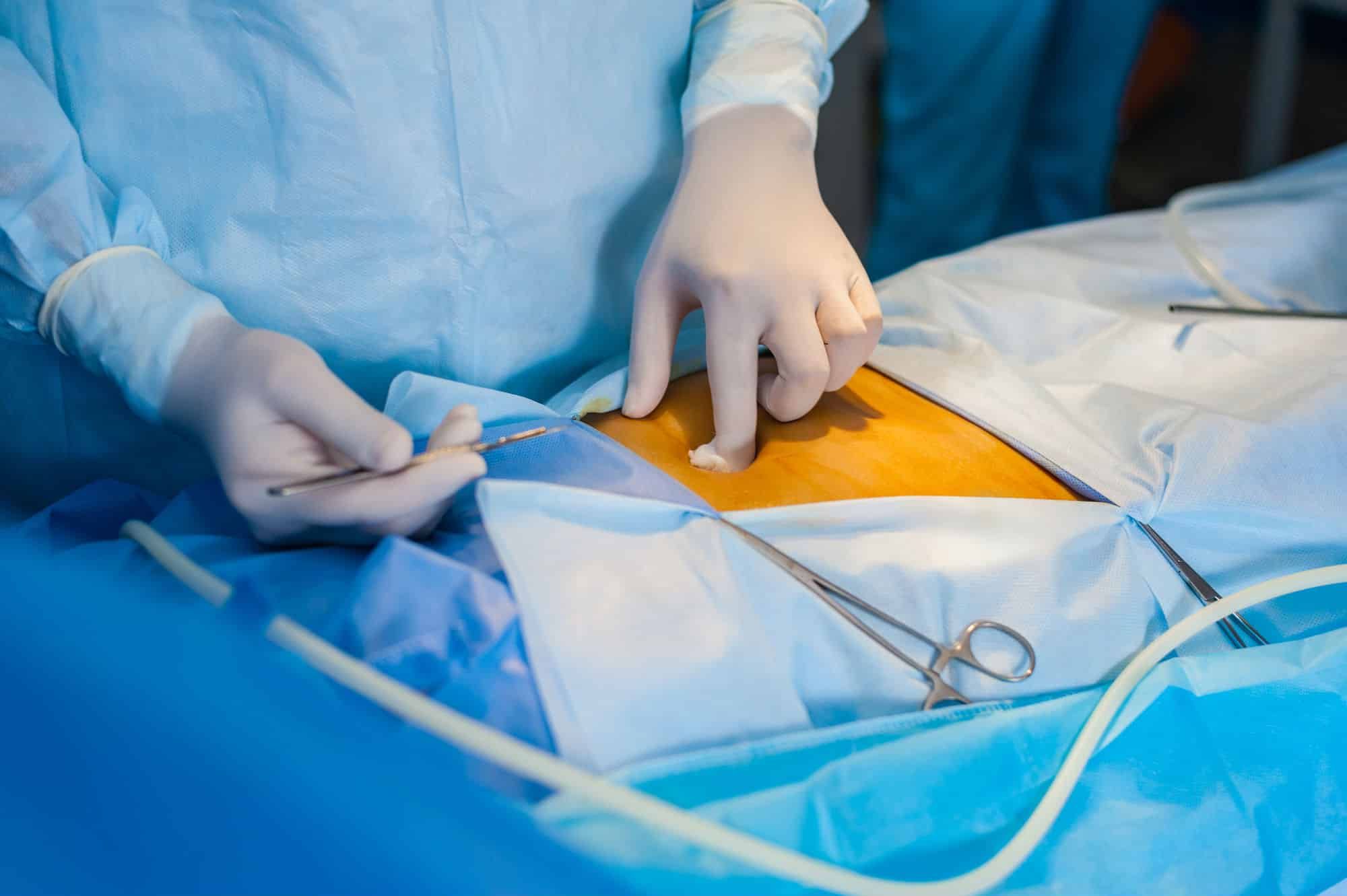 How Do I Know If My Hernia Mesh Is Torn 