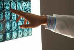 Doctors may be able to partially treat cerebellar ataxia.