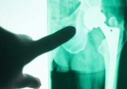 Doctor's hand points to metal hip implant in x-ray