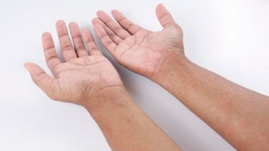 arms and hands with allergic rash
