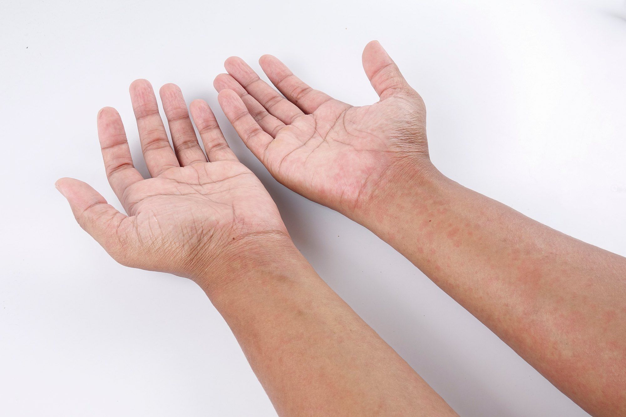 arms and hands with allergic rash