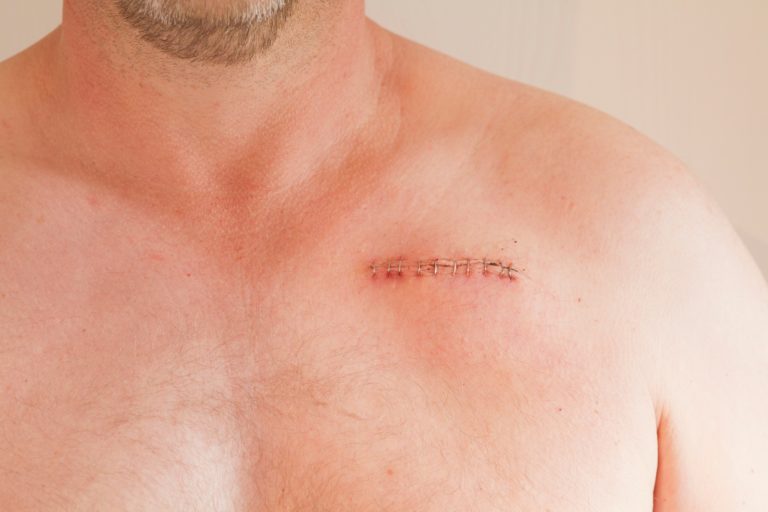 Have You Experienced a Surgical Staple Injury?