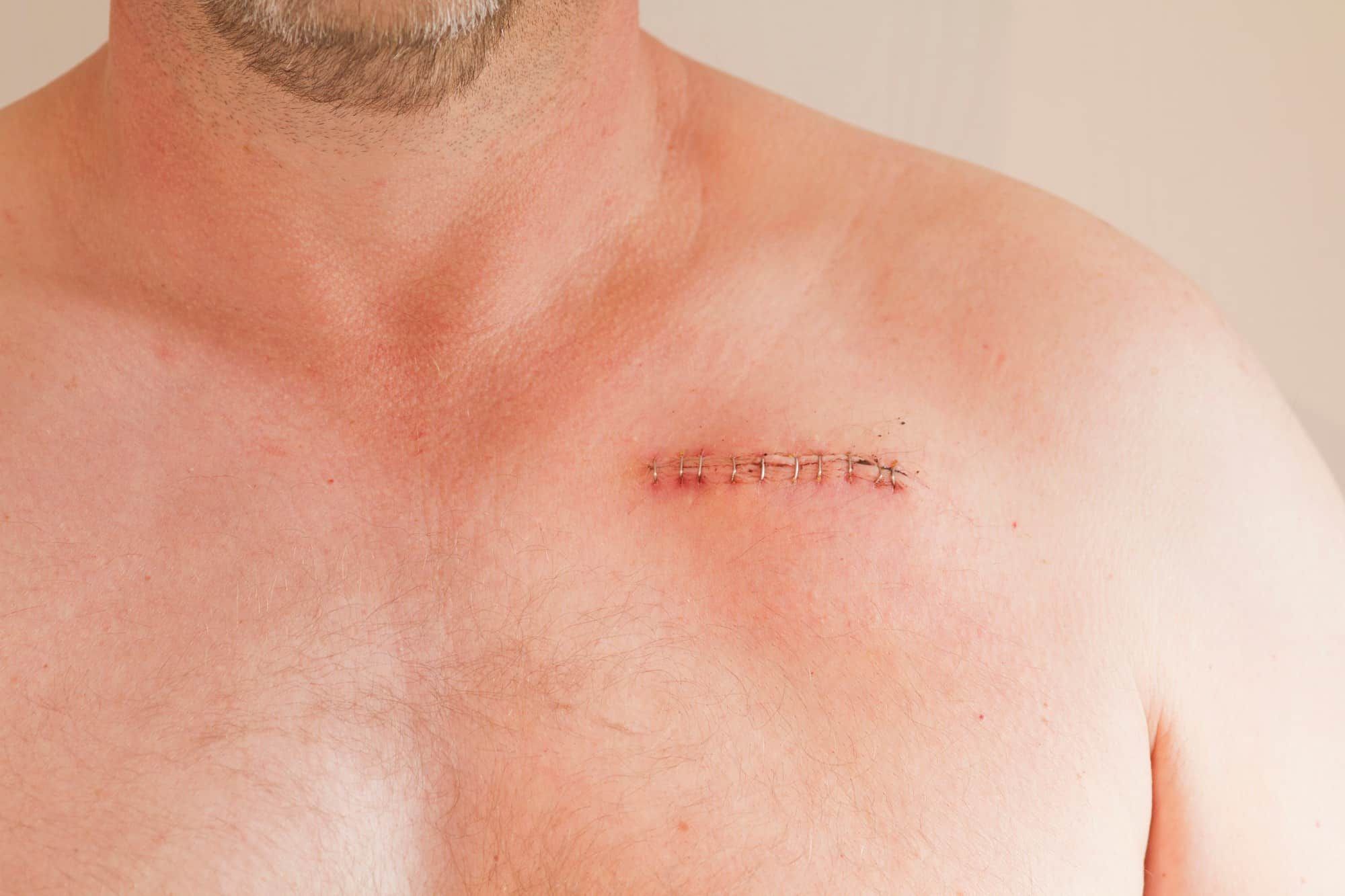 Have You Experienced a Surgical Staple Injury?