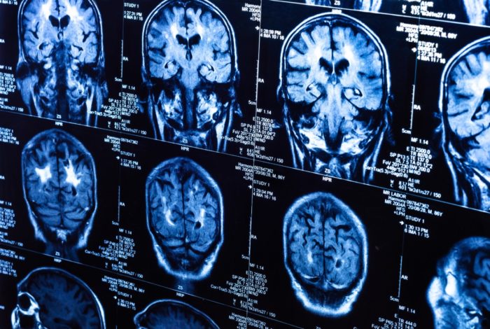 Traumatic Brain Injury Lawsuit Investigation | TBI Attorney