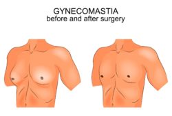 Vector of gynecomastia