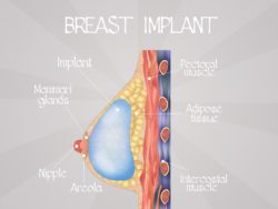 breat implant diagram