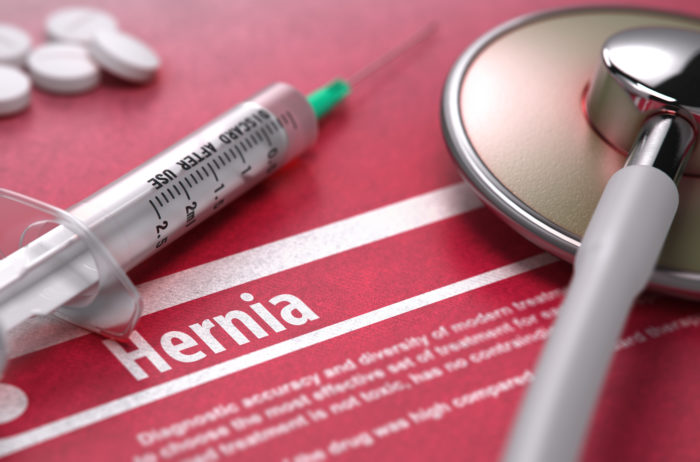 Hernia mesh defects are causing extra surgeries and issues for patients
