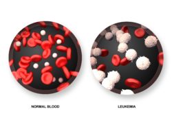 Diagram shows normal blood versus leukemia