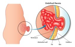 Diadram of an umbilical hernia