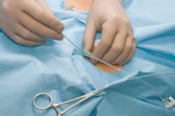 Catheter defect prompts recall.