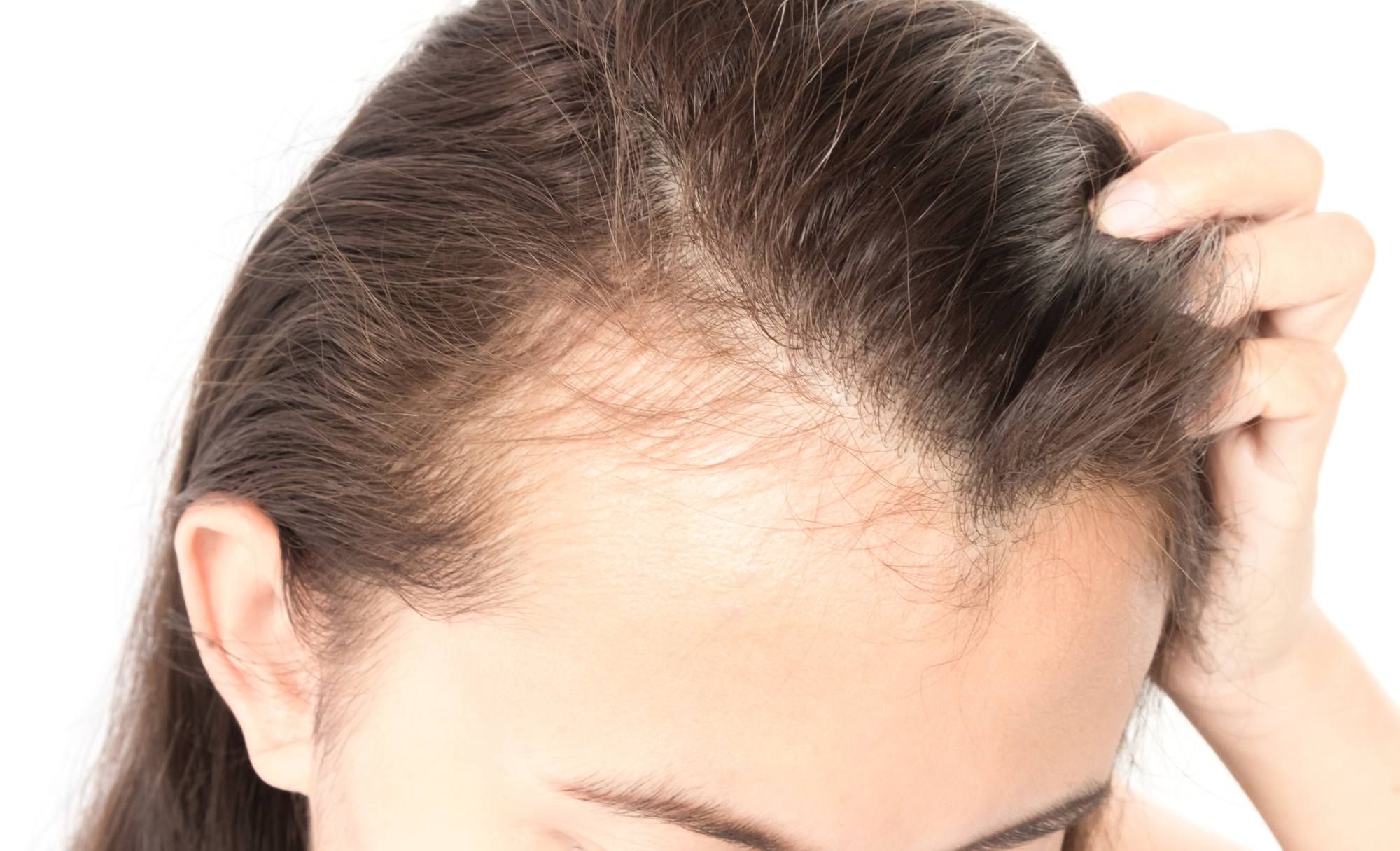 Walgreens sold a female hair loss product for more, class action lawsuit claims.