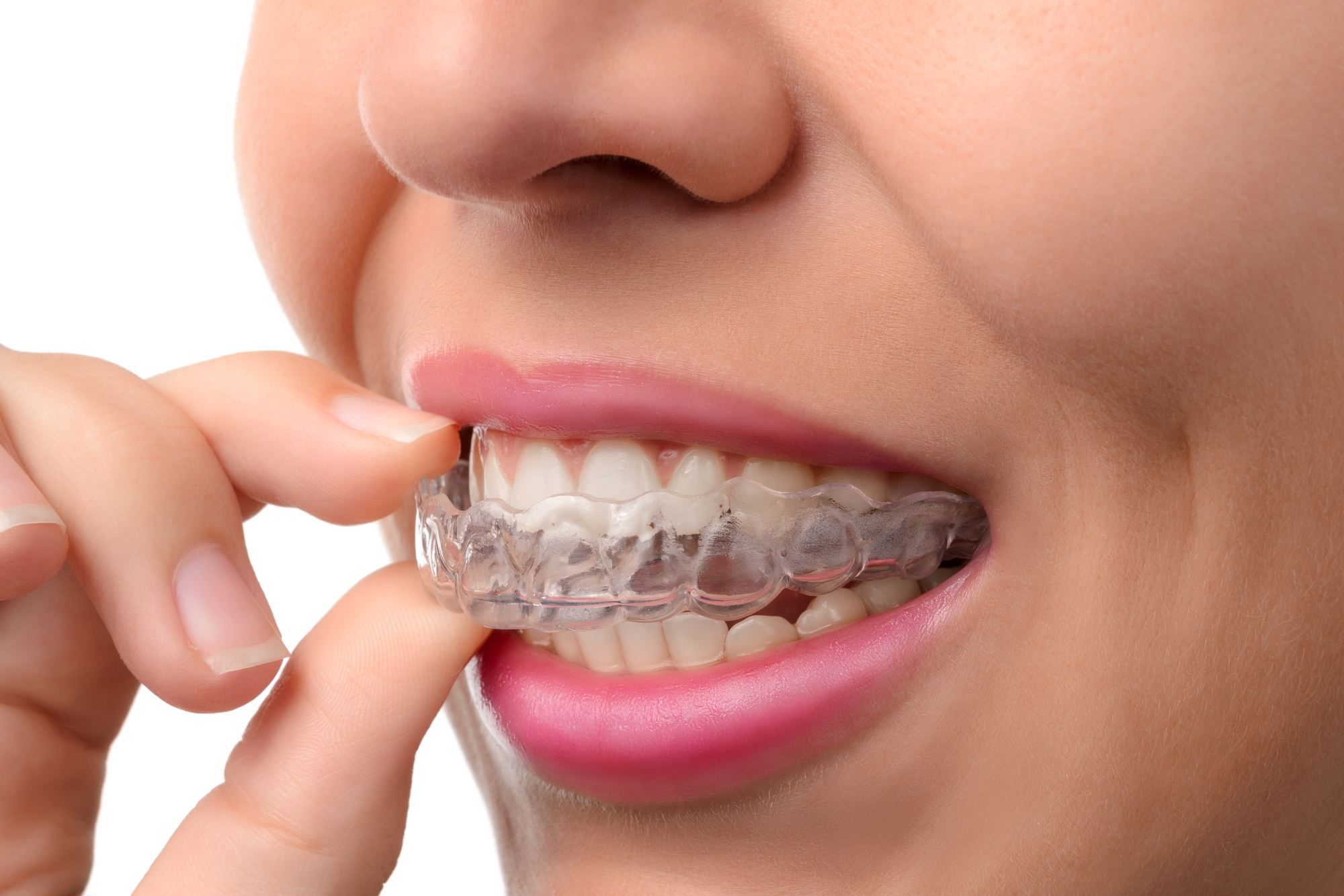 Invisalign Holds Monopoly and Overcharges Customers, Class Action Alleges