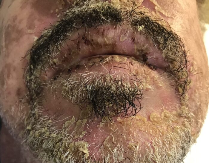 Stevens Johnson syndrome in a man with severe seborrheic dermatitis.