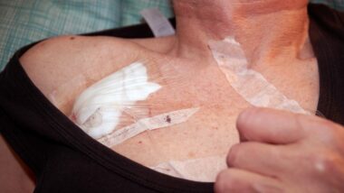 elderly patient with a Port catheter for injecting the fluid drug in the hospital wardroom. PowerPort problems may include infections, clotting, bleeding, pain and death.
