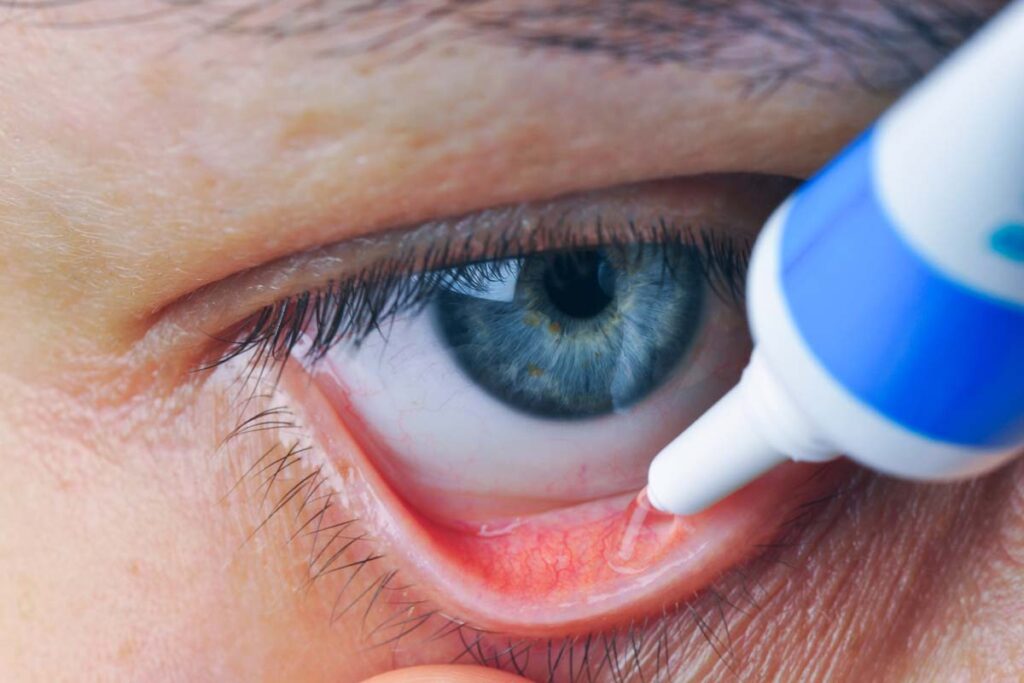 Close up of eye ointment being put into eye, representing the eye ointment recall.