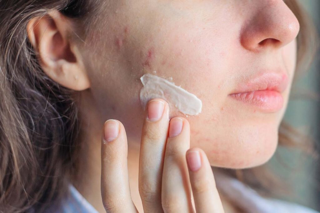 Close up of a woman applying acne treatment to her skin, representing benzoyl peroxide class actions.