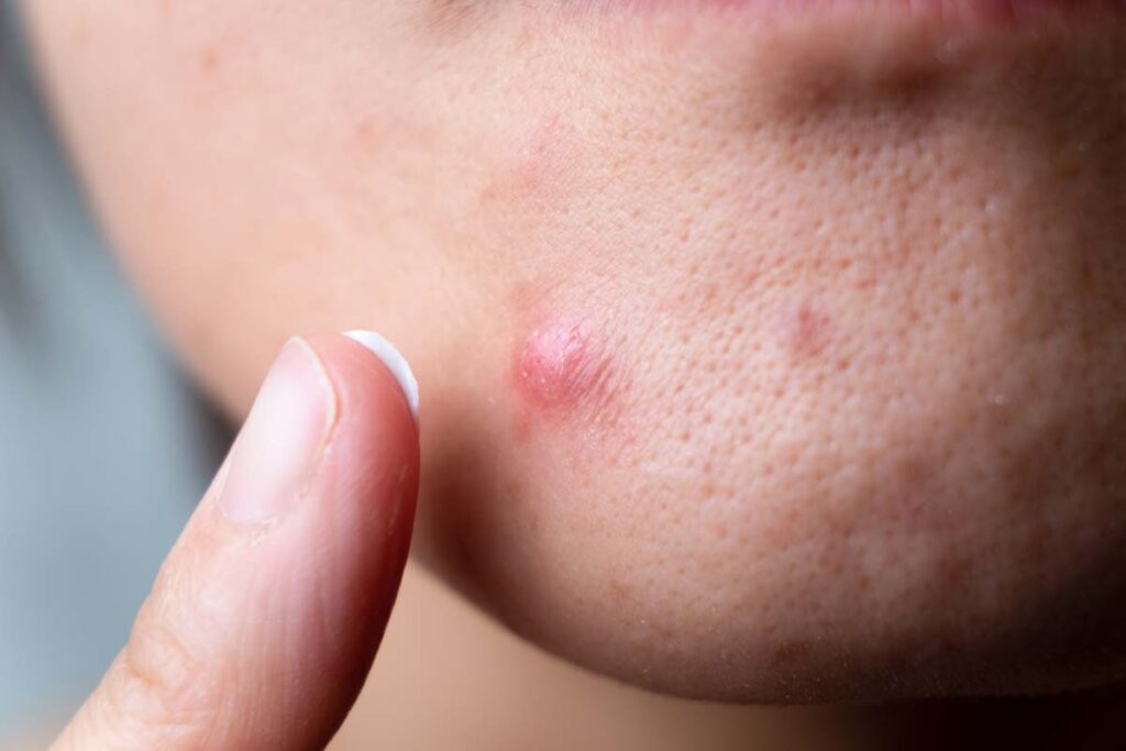 Close up of woman putting acne spot treatment cream on a pimple, representing the Johnson & Johnson benzoyl peroxide benzene content class action.