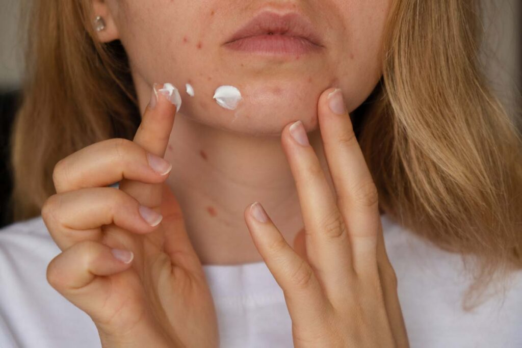 Close up of a woman applying a spot acne treatment, representing the Clinique class action.