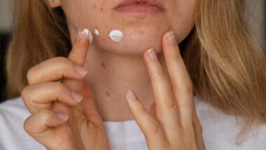 Close up of a woman applying a spot acne treatment, representing the Clinique class action.