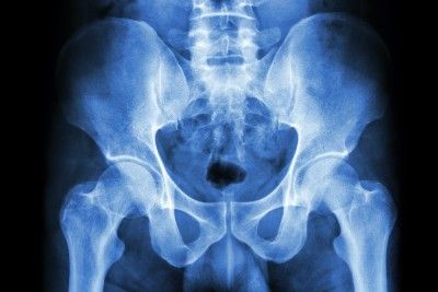 Xray of pelvis - IMMDS review of pelvic mesh reveals UK health system failed women