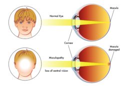 Malculopathy illustration regardsing the Elmiron class action lawsuit alleging vision damage