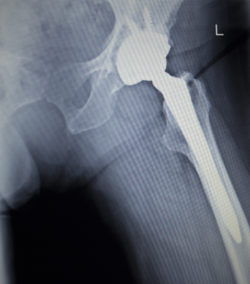 The claims period in the Stryker implants class action settlement opened on March 30, 2020 entitling those who were implanted with an allegedly defective hip implant system potentially thousands of dollars in awards.
