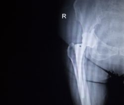 Hip implant X-ray regarding the Wright Profemur Hip Implant Class Action Settlement rescheduled 