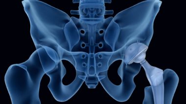 an Xray of a hip implant regarding the Wright defective hip implant settlement