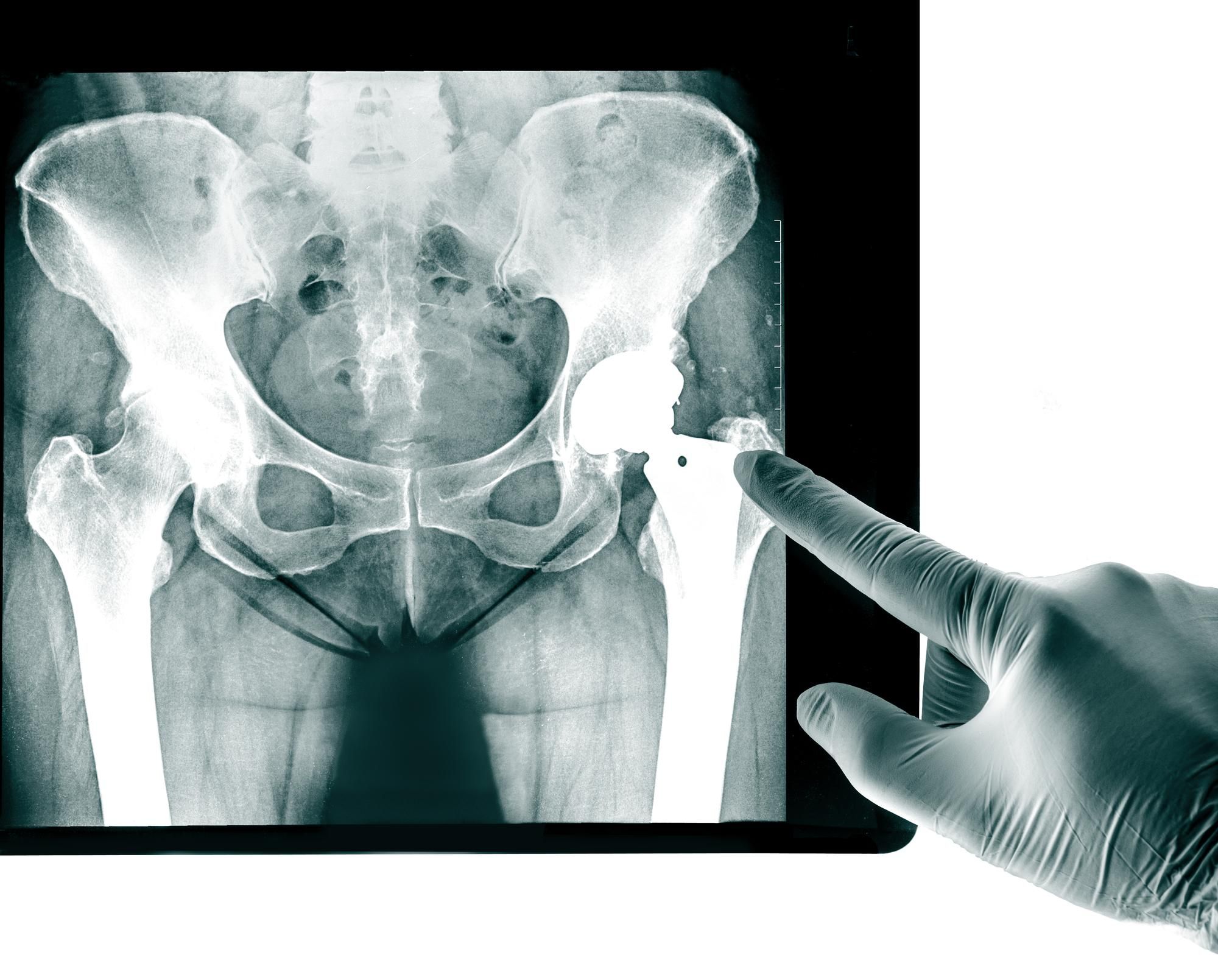 $15.5M ASR Hip Implant Class Action Settlement Proposed